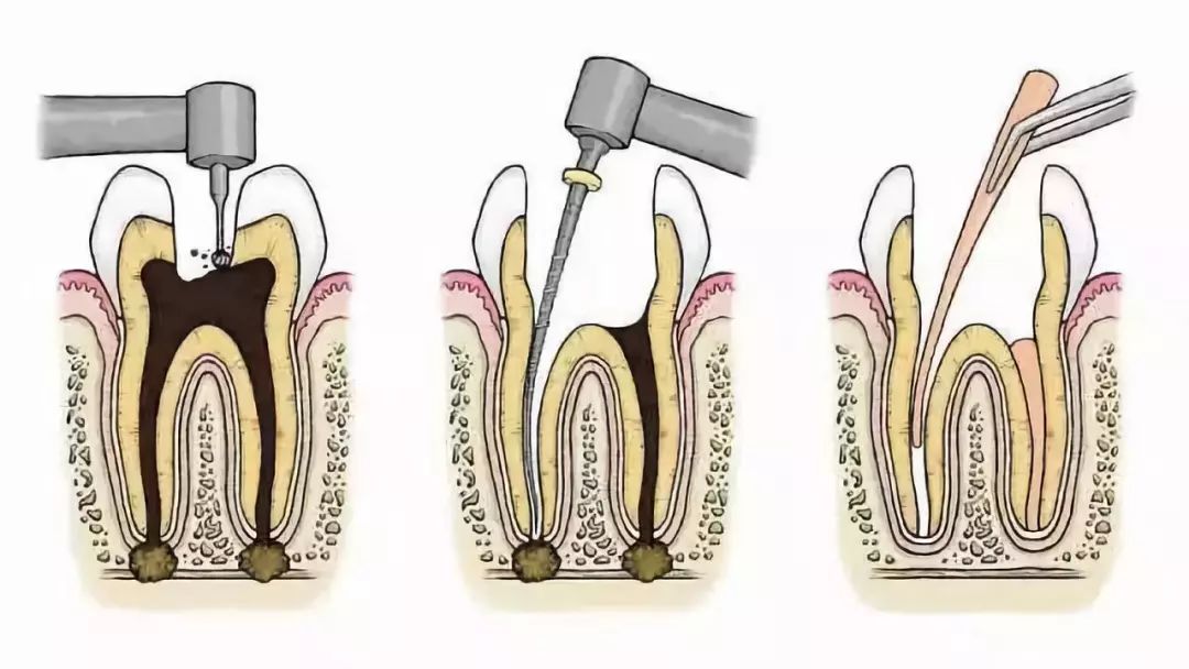 Root Canal Preparation Machine