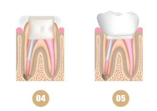 Root Canal Preparation