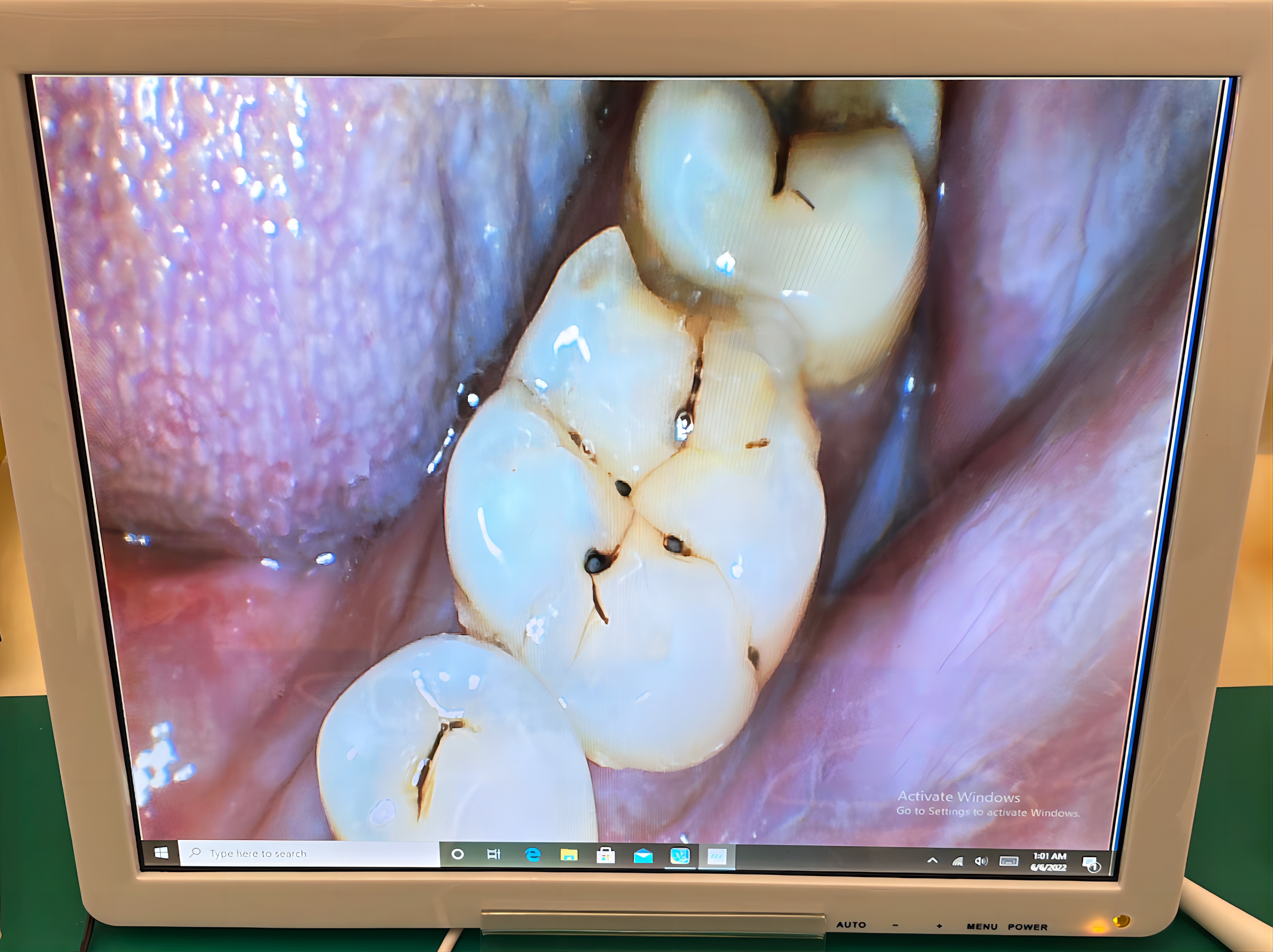 oral endoscope with computer