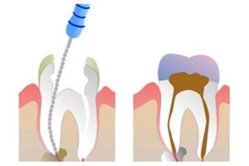 Precautions after root canal treatment