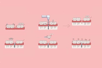 Dental Implant Process