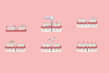 Processus d'implant dentaire