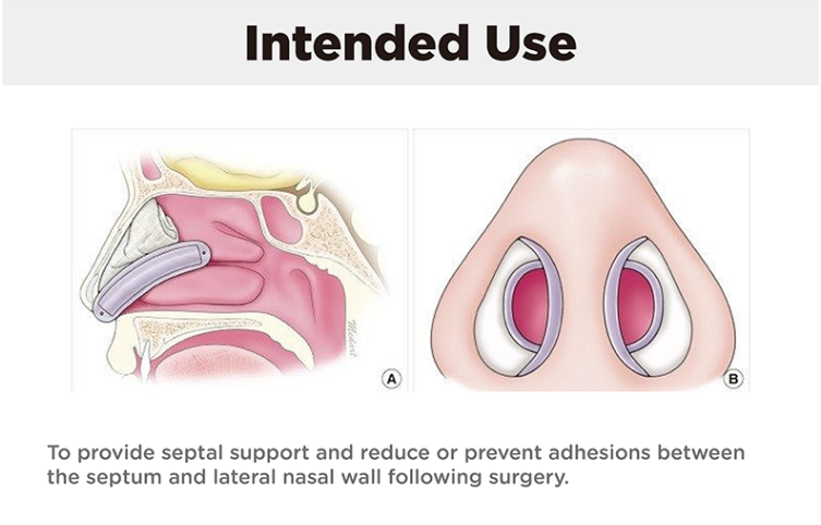 Rhinoplasty Silicone Splint