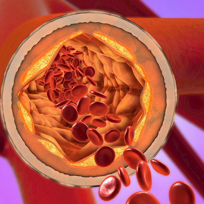 ثلاثة عناصر فحص لتشخيص فقر الدم، الجزء 3: فيتامين ب12