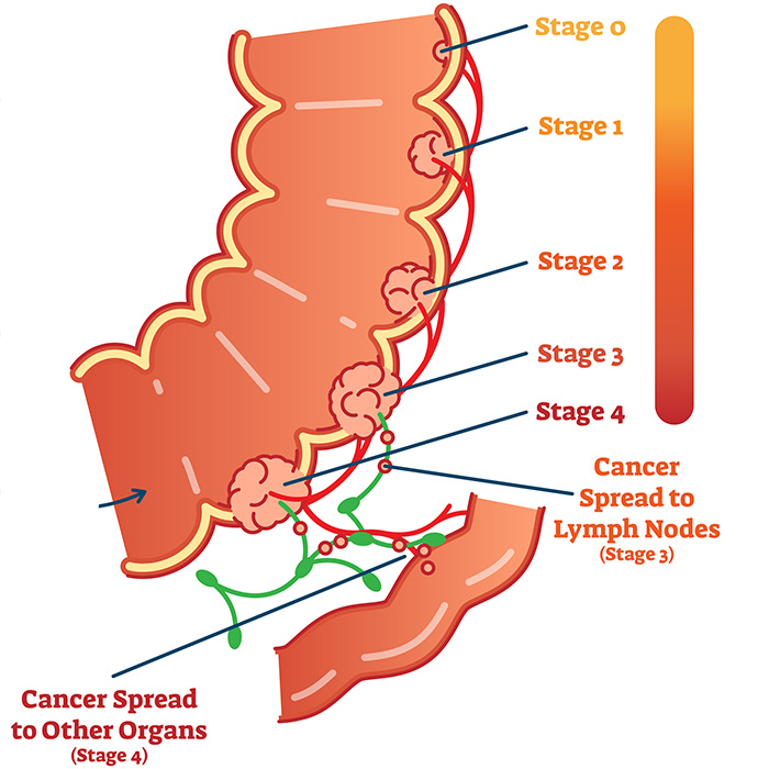 The Advantages of Fecal Occult Blood Test in Widespread Colorectal Cancer Screening