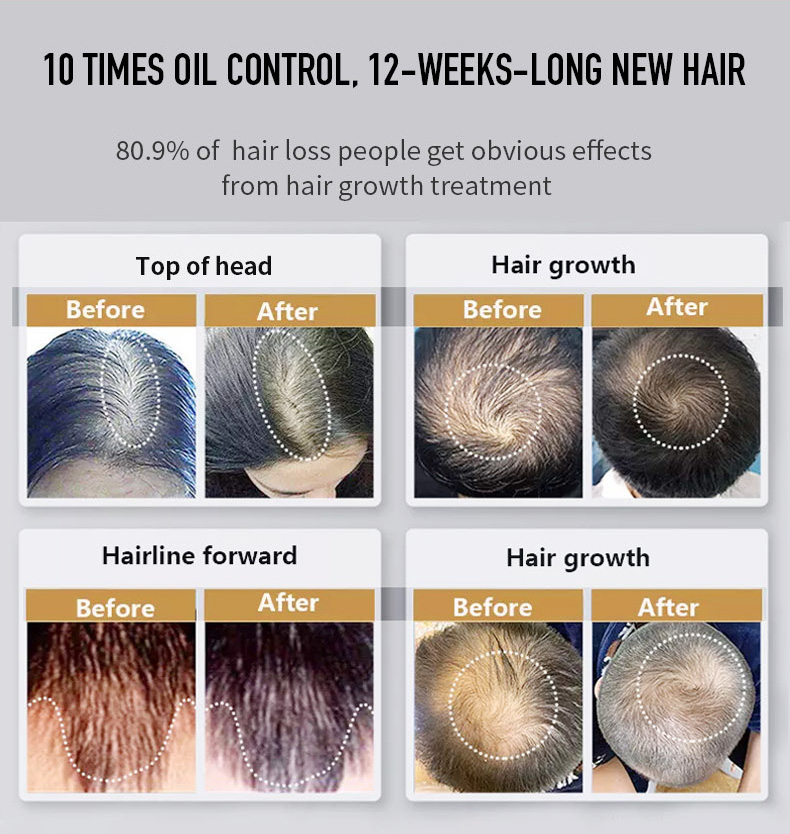 Supply Pressure Caused Hair Loss Treatment Cap Wholesale Factory