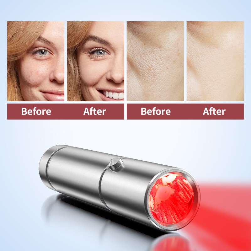 Supply Cold Sores LED And Laser Treatment Torch Wholesale Factory Hubei Fithope Technology Co