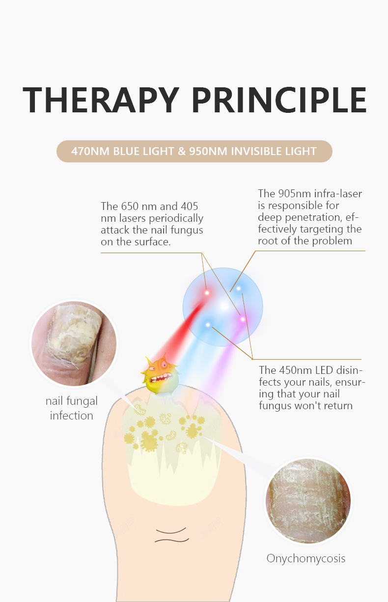 Supply Portable Laser Toenail Fungus Treatment Machine Wholesale