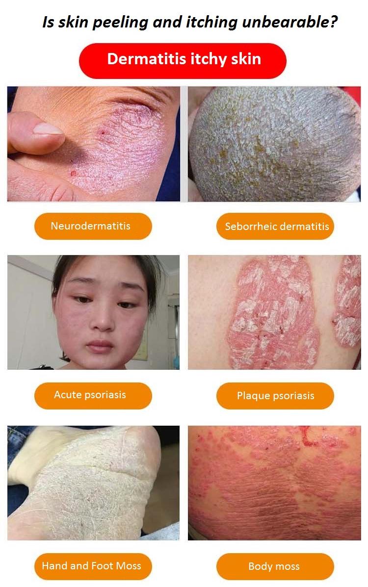 betamethasone cream