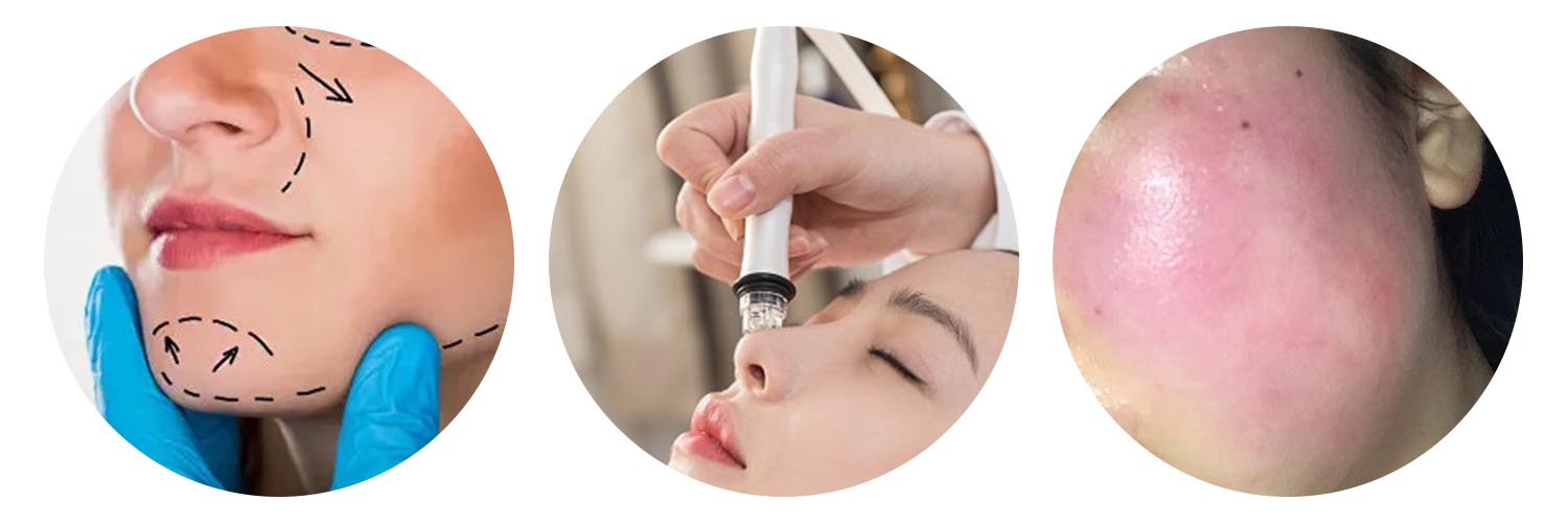 Recombinant Mussel Mucin Repair Dressing Launch: A Breakthrough in Skin Barrier Repair!