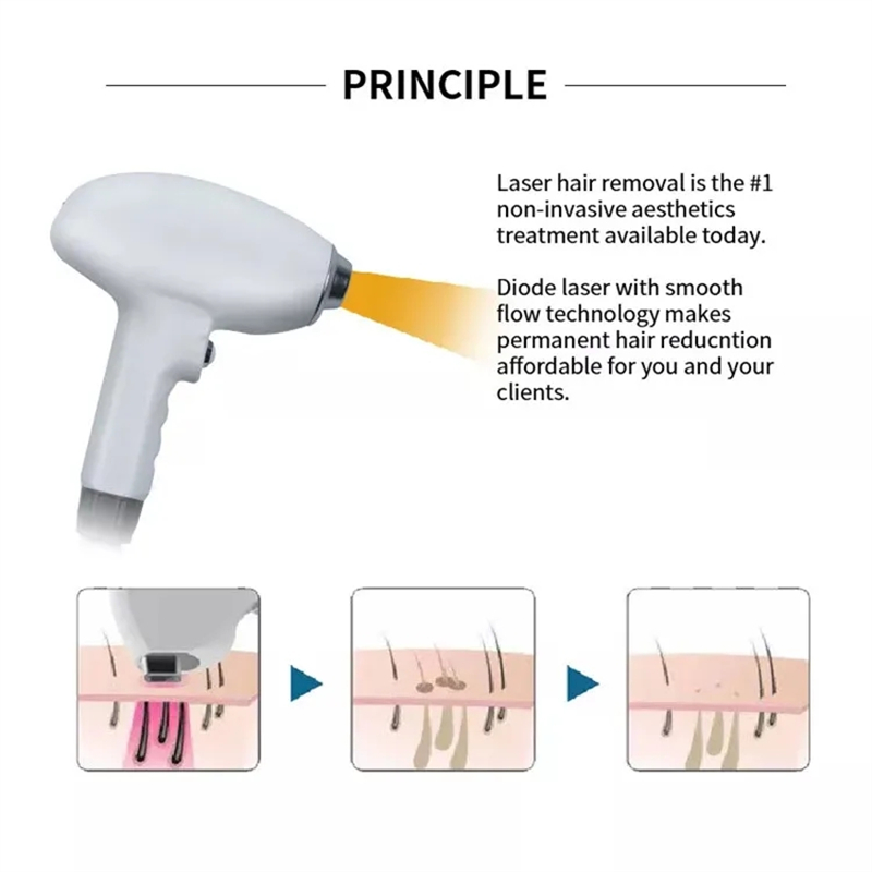 laser hair removal machine