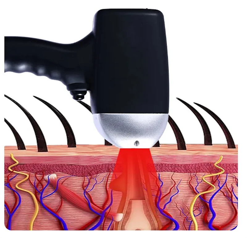 laser hair removal device