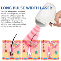 Laser Pico Tattoo And Body Hair Epilation Removal Machine