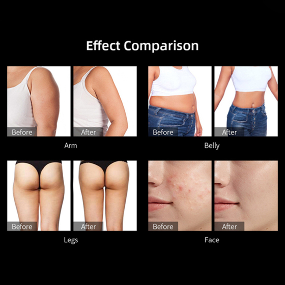 Weight Loss Machine – What Types of Weight Loss Machines Are There?