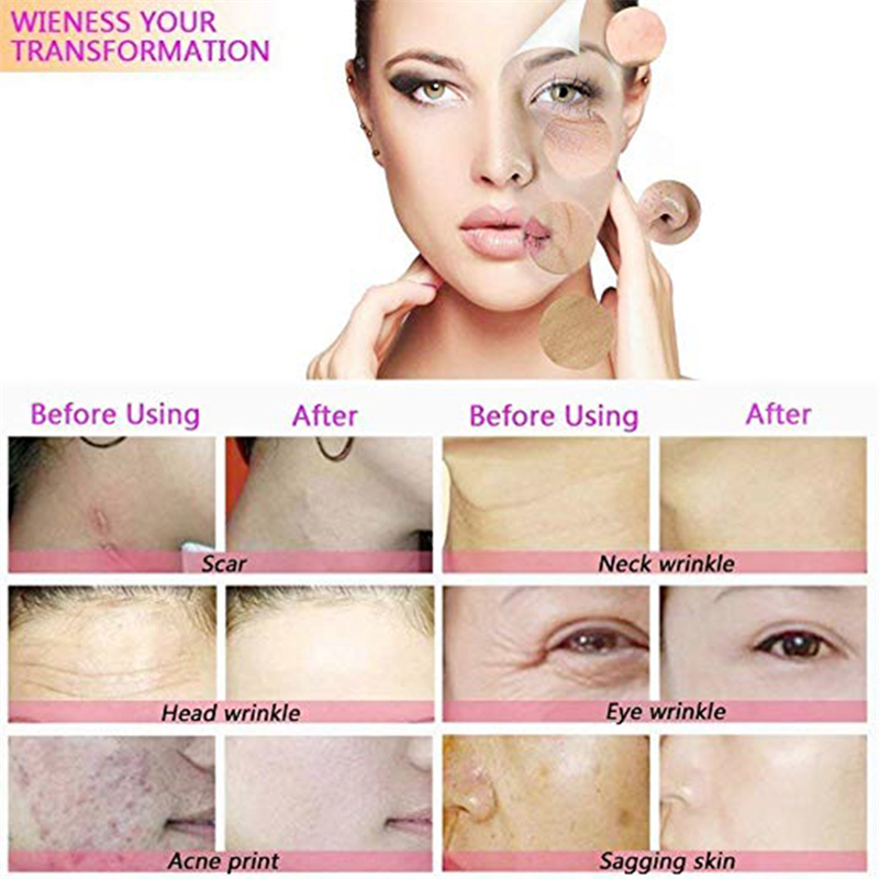 diamond microdermabrasion machine