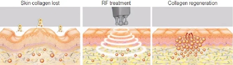 ultrasonic cavitation machine