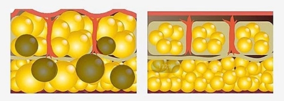 What happens to adipocytes when we lose weight intensively?