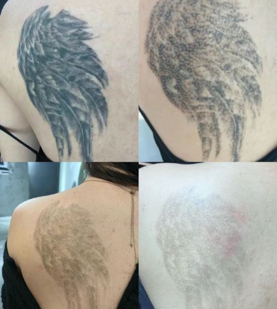 Laser Tattoo Removal Treatment Overview
