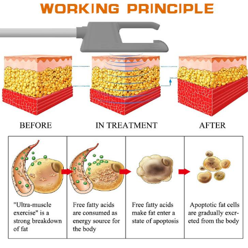 fat reduction machine