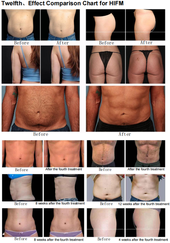 fat reduction machine