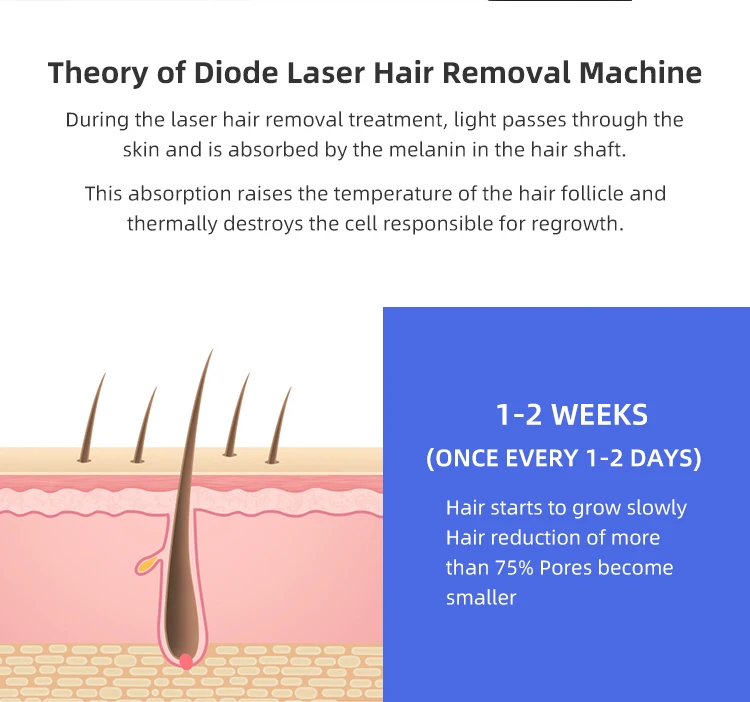 laser hair removal