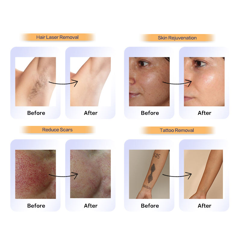 laser epilation machine