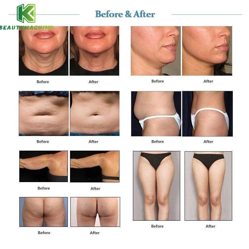 ultrasonic cavitation