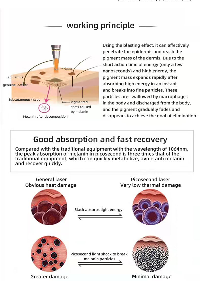 laser hair removal
