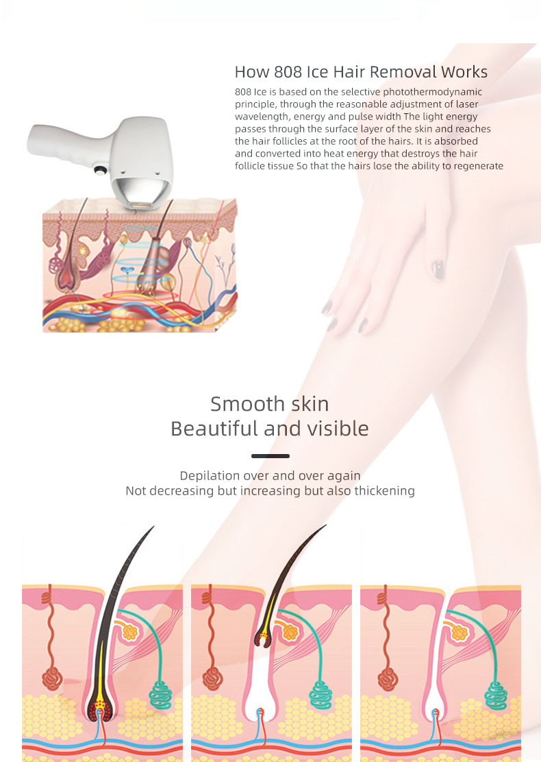 laser hair removal device