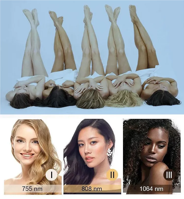 laser hair removal machine