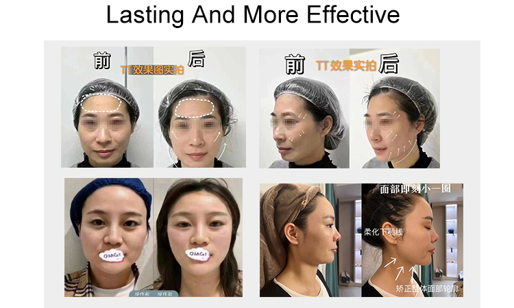 ultraformer face lift