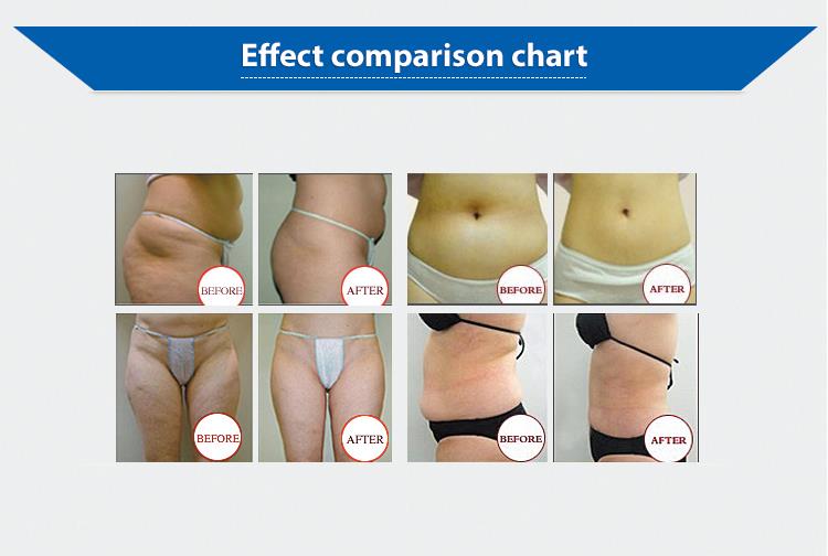 cryolipolysis fat freezing machine