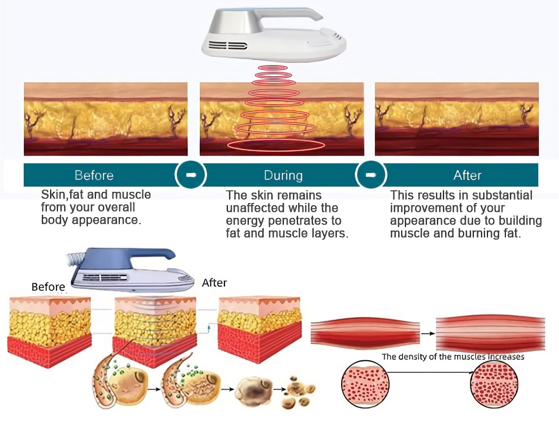 hiemt emsculpt