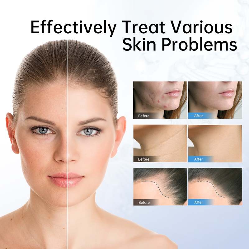 Dr Pen Ultima Dermapen 12 Needle Microneedling Skin