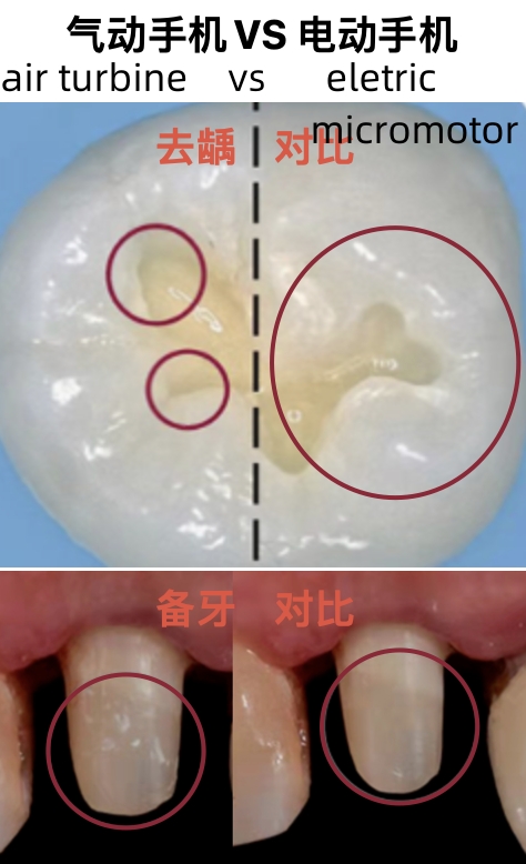 increasing contra angle