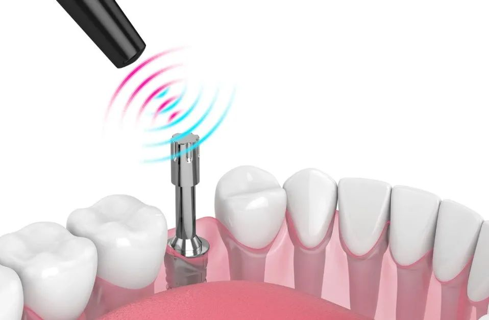 monitor osseointegration