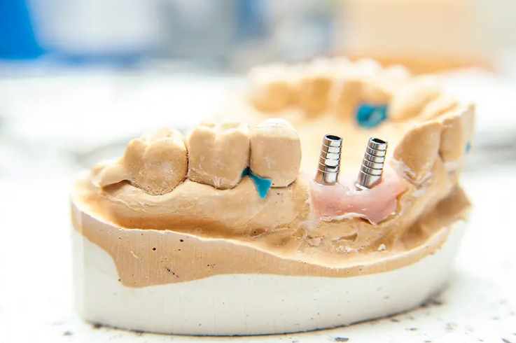 Dental Implant Surgery
