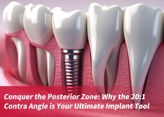 Conquer the Posterior Zone: Why the 20:1 Contra Angle is Your Ultimate Implant Tool