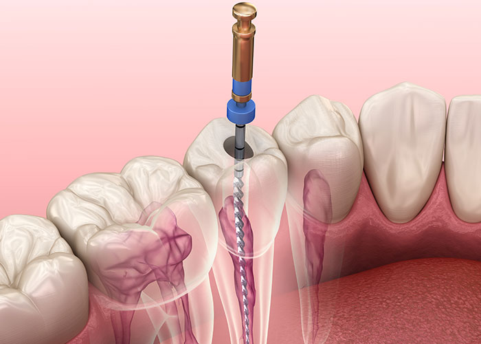 The H-File: A Endodontic Workhorse for Precision and Power The H-File: A Endodontic Workhorse for Precision and Power