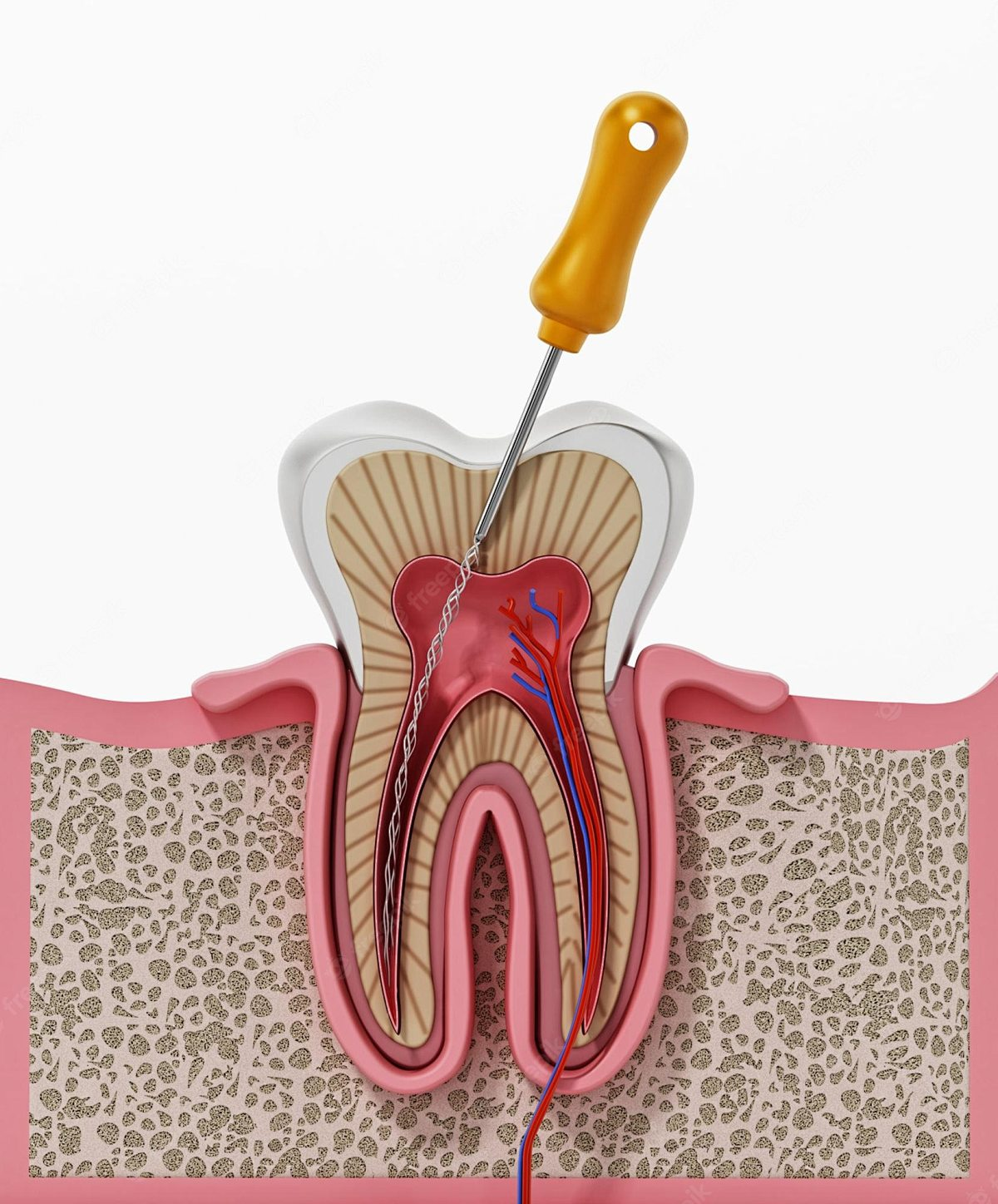 endodontic instruments