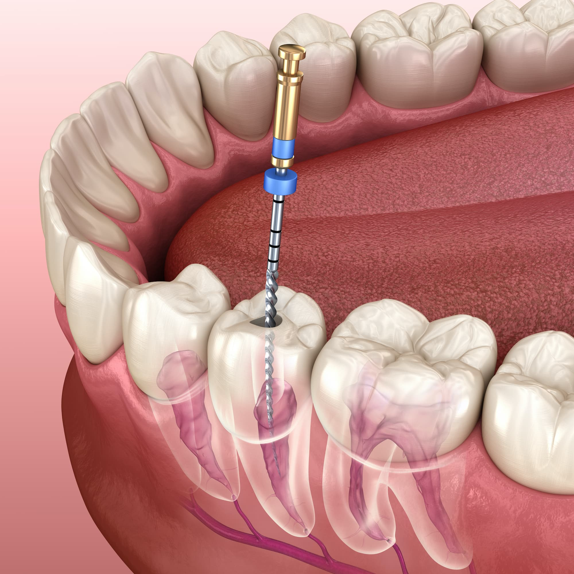 dental tooth file