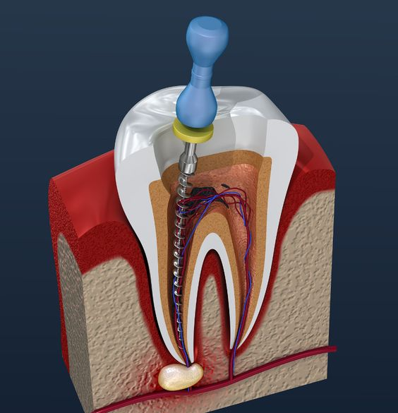 endodontic instruments
