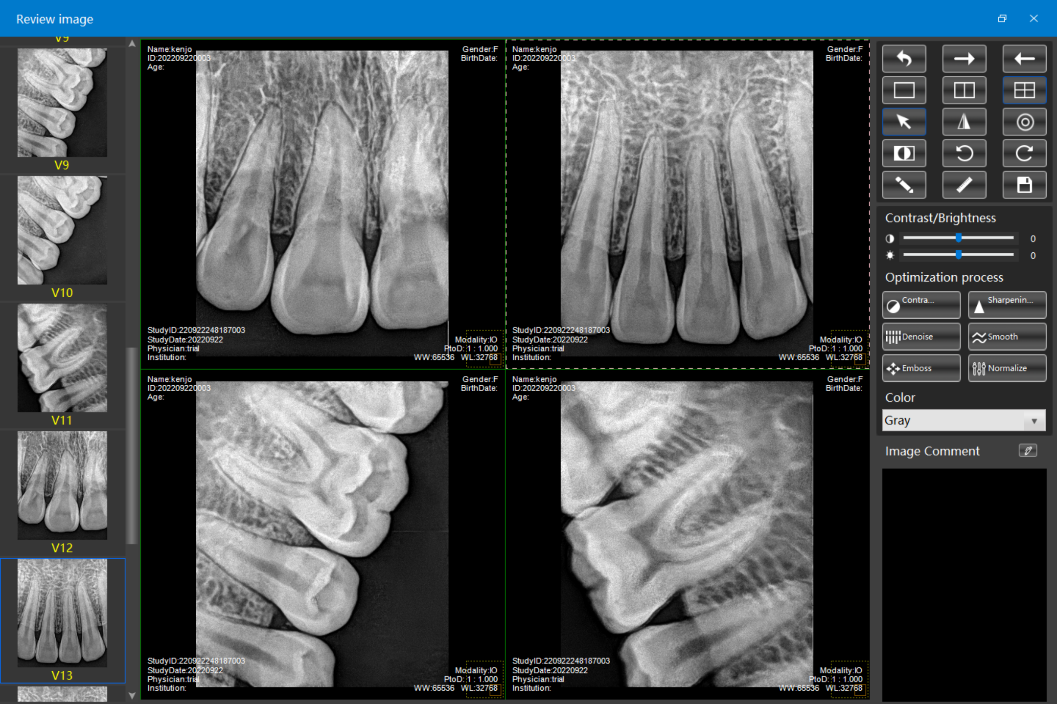 dental gun x-ray machine