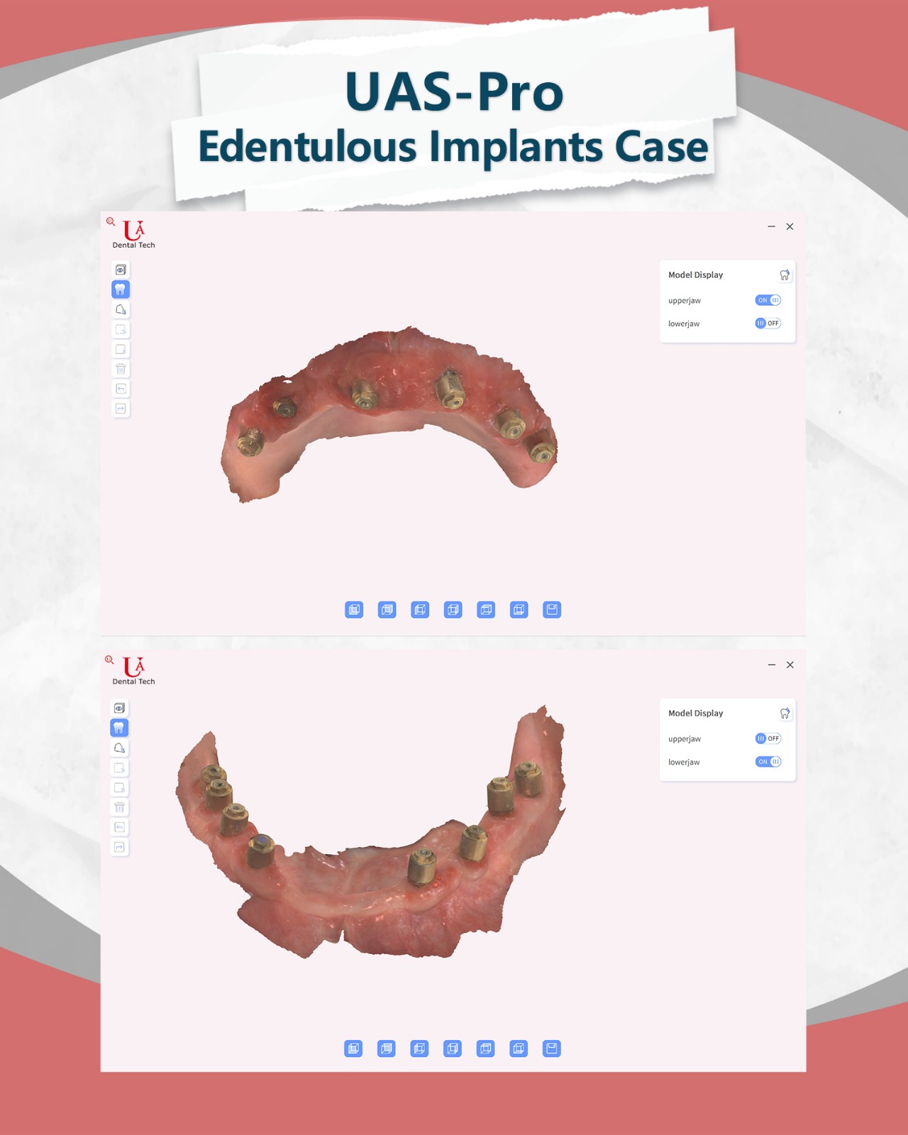 dental intraoral scanner