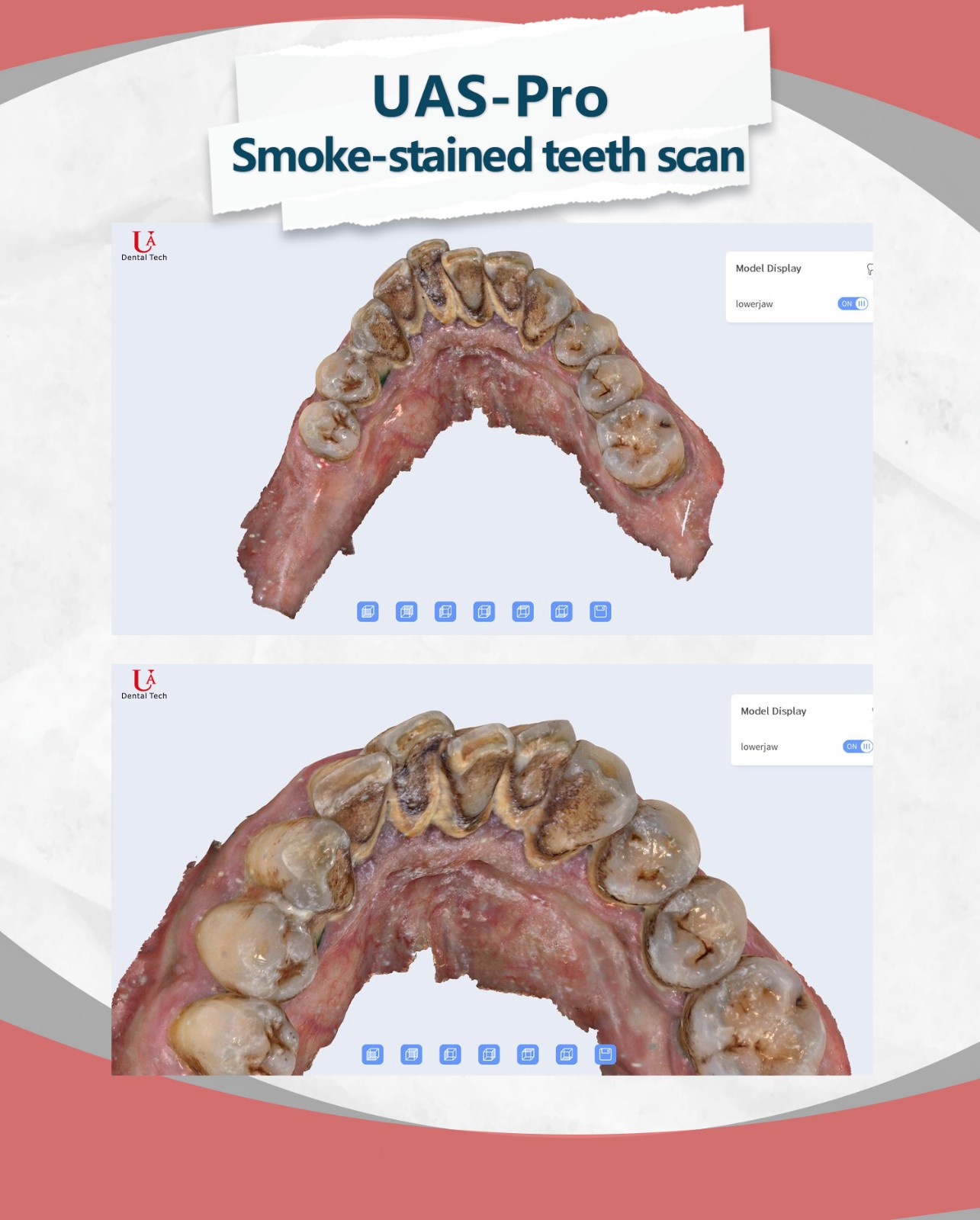 3d dental scanner