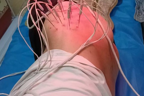 中医：内热针灸治疗腰椎病