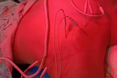 Acupuntura con calor interno para aliviar el dolor e hinchazón de hombros y escápulas