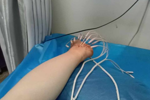 右踝关节外侧骨折六个月后内热针灸