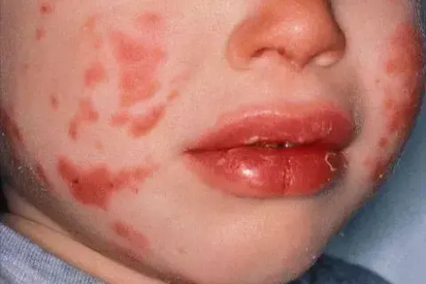 中医育儿：问题二 孩子皮肤过敏怎么办？
