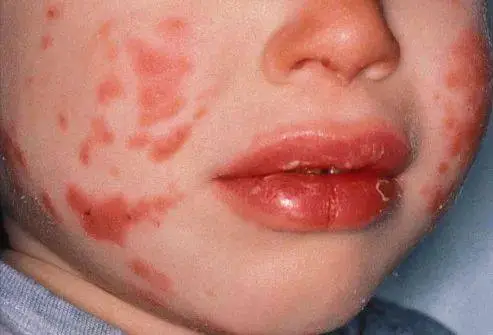 skin allergy treatment